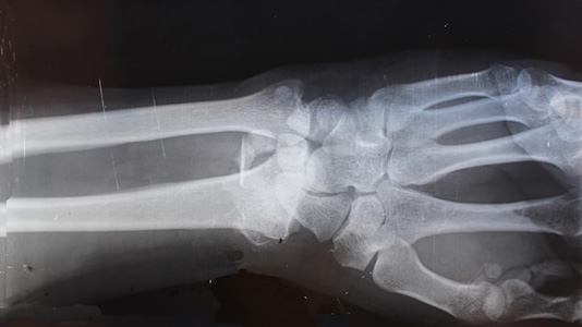 X-ray of arm and hand